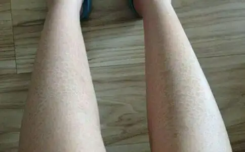 男子全身长满鱼鳞三大原因导致鱼鳞病