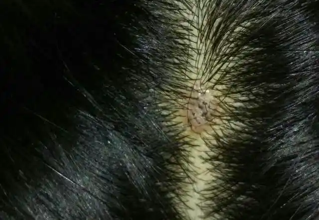 洗头时,头皮上鼓鼓的小疙瘩是啥?到夏天,多久洗一次头最科学?