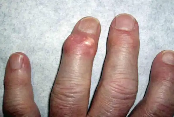 痛风早期症状图片 (57)