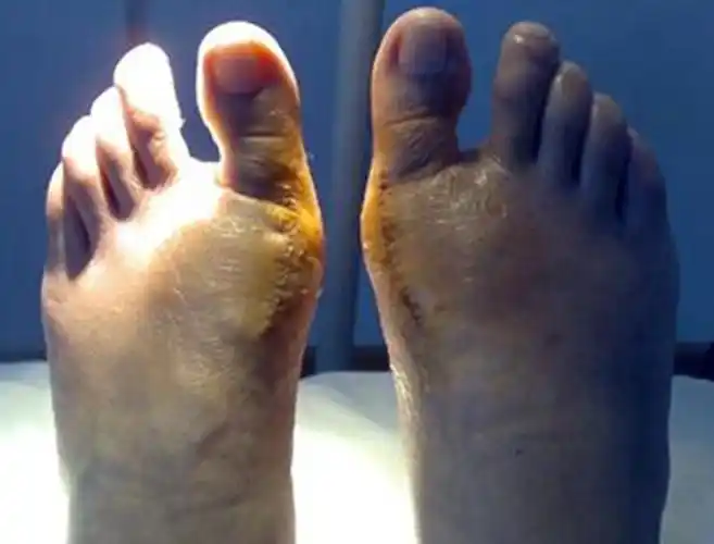 北京拇外翻医院_北京治疗拇外翻哪家医院好_北京治疗拇外翻最好的医院