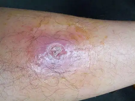 本人小腿长了个疖疮,已经用药半个月了,并且输了5天液.