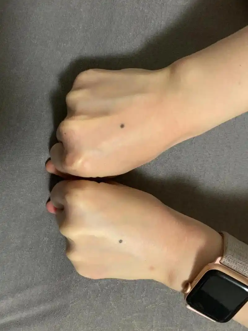 关于手背长痣/ 愿一生幸运 自我记事起,左右两只手背就有两颗对称的小