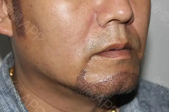 种植胡须 鬓角 眉毛第三天