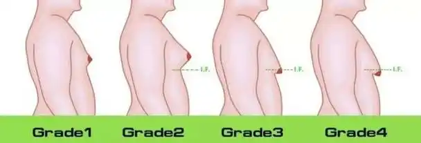 "男性乳腺发育异常近些年在临床上并不少见.