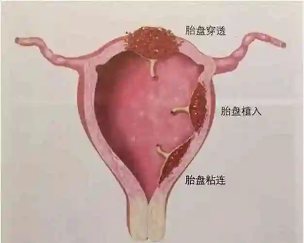孕28周产检胎儿鼻骨未显示胎盘前置状态需要注意些什么