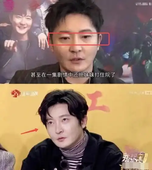 40岁郭京飞眼袋手术出现事故!