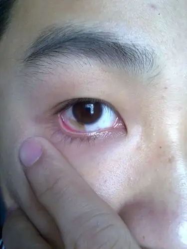 我的眼睛的白色部分有点血斑,有没有问题?会不会是什么疾病?