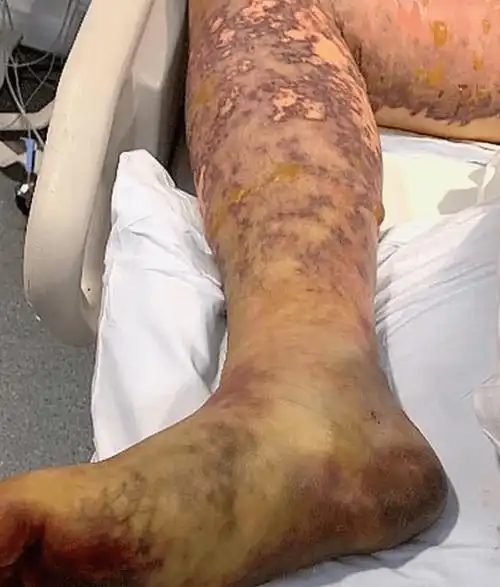 恐怖学生吃外卖剩饭致截肢双腿10根手指多器官衰竭