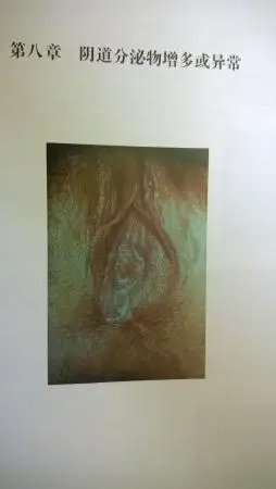 1,男性尿道分泌物  2,阴道分泌物增加或异常  3,生殖器溃疡  4,阴