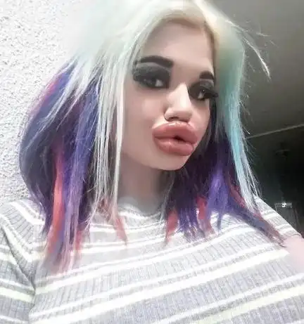 原创丰唇20次她整成世界最大嘴唇的真人芭比