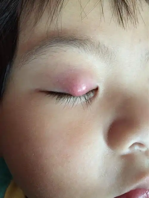 宝宝得了霰粒钟一直不好,这几天左眼眼皮上鼓起来了个疙瘩鼓励还是霰