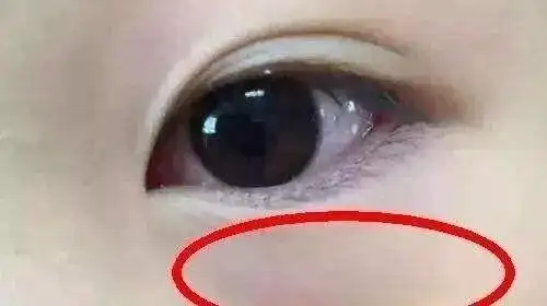 93看下眼睑就知道宝宝是否积食