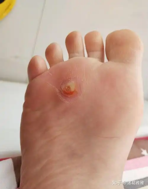 长了鸡眼怎么办鸡眼怎么去除