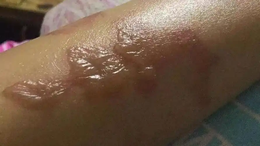 震惊双皮奶爆炸一女子烫伤毁容原因你想不到