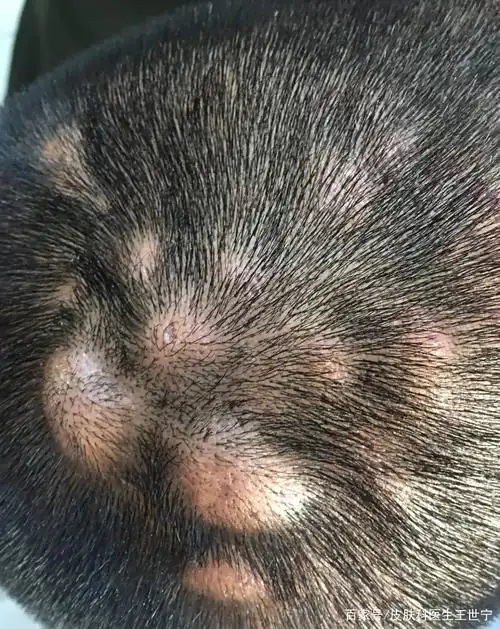 穿掘性毛囊炎!