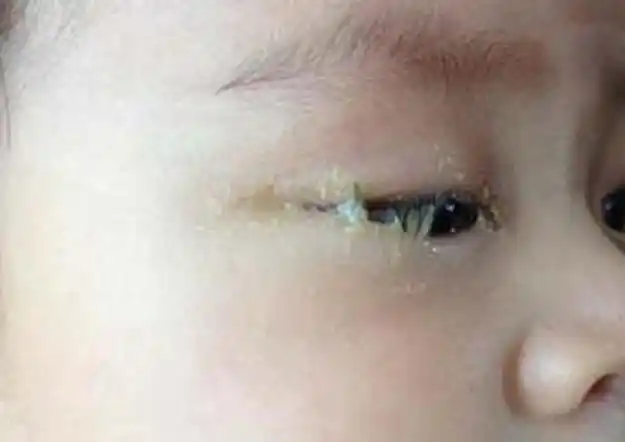 5岁宝宝眼睛"看不见了",家人以为没睡好,检查后医生:来晚了