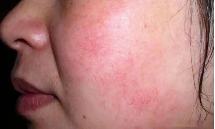 角质层薄用什么洗面奶角质层薄用什么洗脸