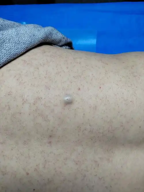 25岁小杨治疗表皮样囊肿手术切除效果好