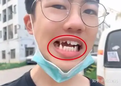 有这样一位宝妈,把自己儿子的"小尖牙"的照片发布在了网上,并进行了