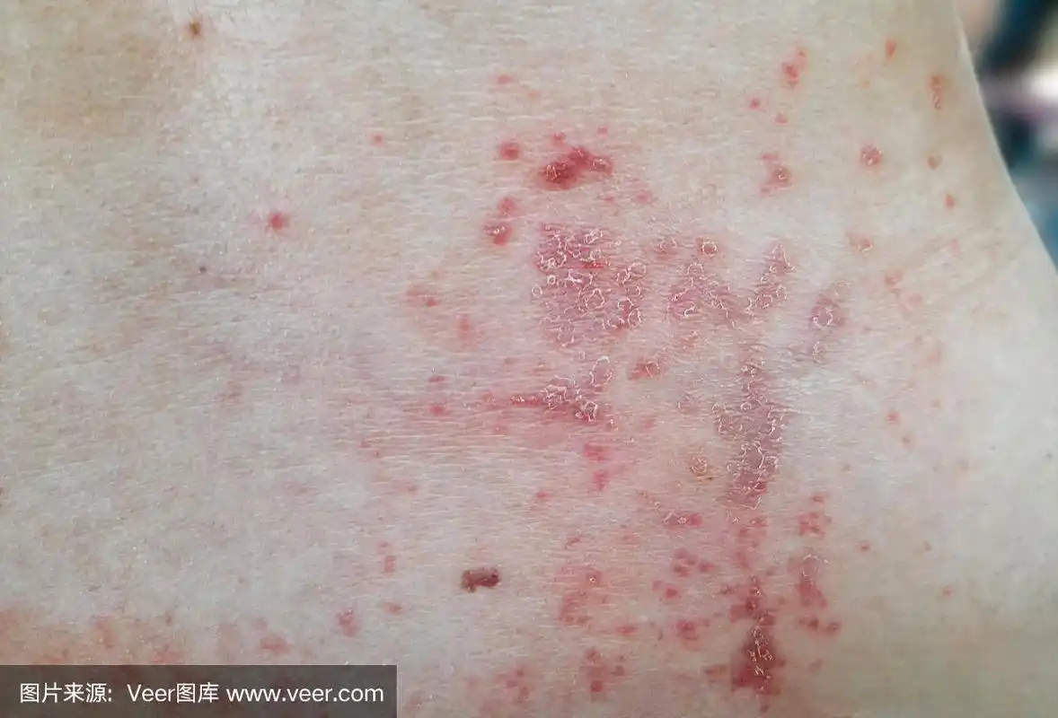 皮肤病亚洲女性背部皮肤痱子或粟疹.