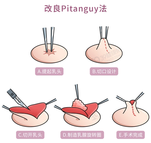 什么是乳头内陷要怎么治疗2个原因可能让它暂时消失