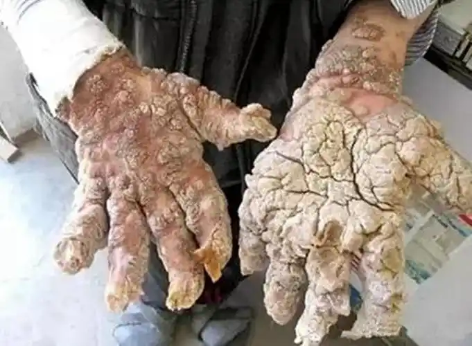 尖锐湿疣菜花初期图片