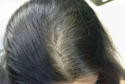 女人掉头发是什么原因