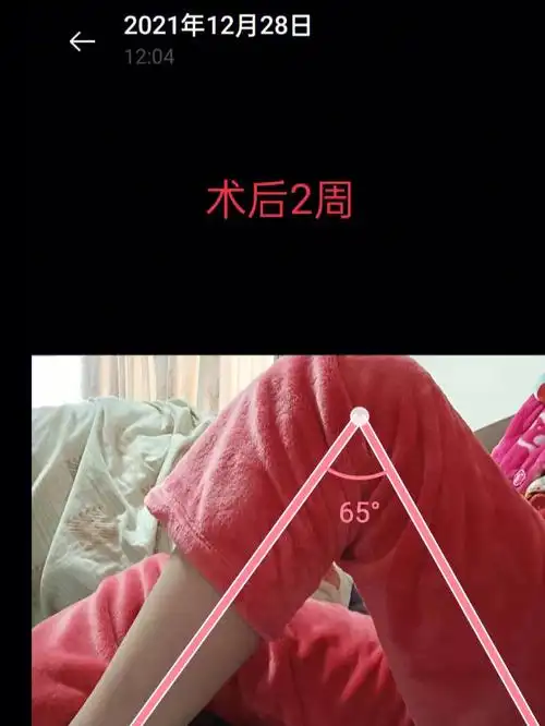 不用掰腿前叉康复每天进步术后2月正常