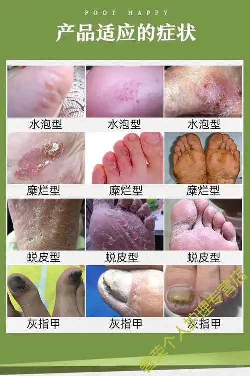百健灵足丫乐去除治真菌王脚臭脚痒脚烂脚丫的药狼毒喷剂认准百健灵
