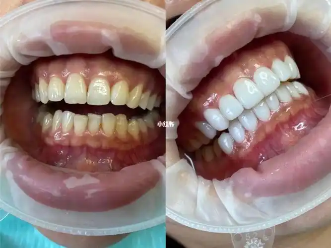 全瓷贴片对比图_牙齿美白_牙线_牙齿保护_美妆_医美整形