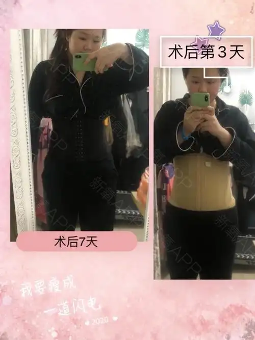 【在杭州格莱美做腰腹环吸的第15天】