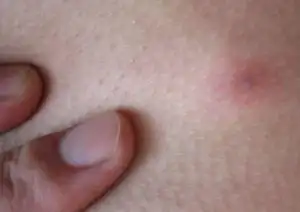 外阴长疖子的症状图片