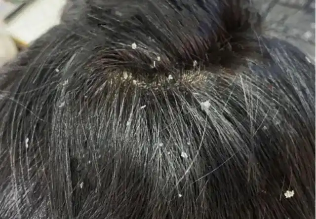 男生头皮屑大片大片的,一挠跟雪花一样,根本洗不干净?小心螨虫作祟!