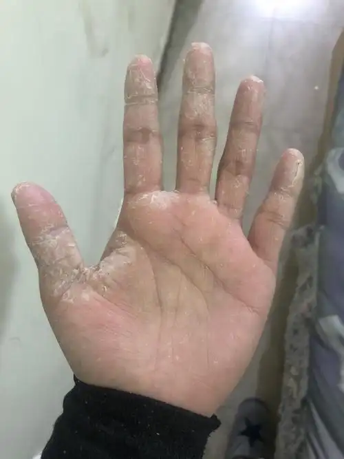 手脚皮肤脱皮