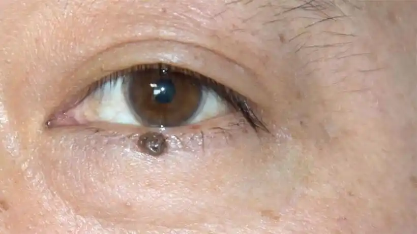 下眼睑这么大一颗黑痣,看看医生是怎么解决它的!