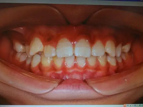 为什么上颌虎牙容易长歪?