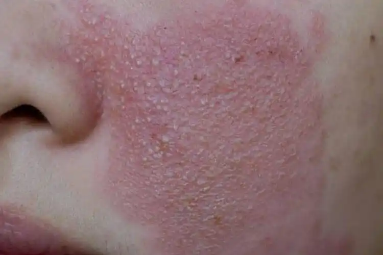 急性接触性皮炎图