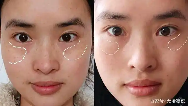 光子嫩肤术后11天,多年的斑点变淡了!