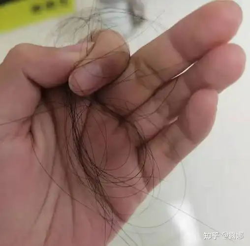 一,【脱发福音 秃头救命水】