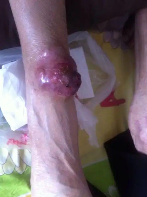 年近九十高龄,腿部长个不知啥瘤,到医院检查也未