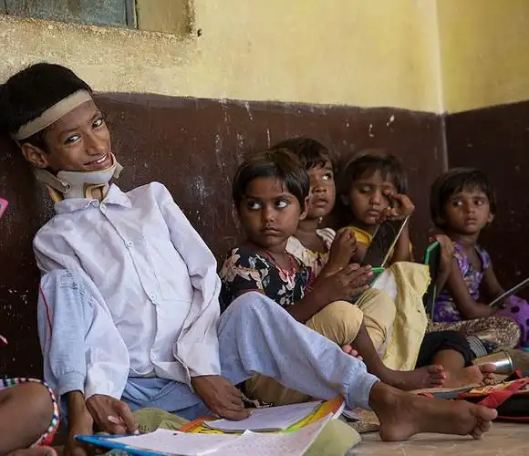 印度男童身患"歪头"怪病 手术后终可正视世界(组图)