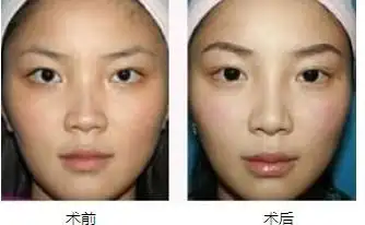 玻尿酸注射隆眉弓术的成功案例
