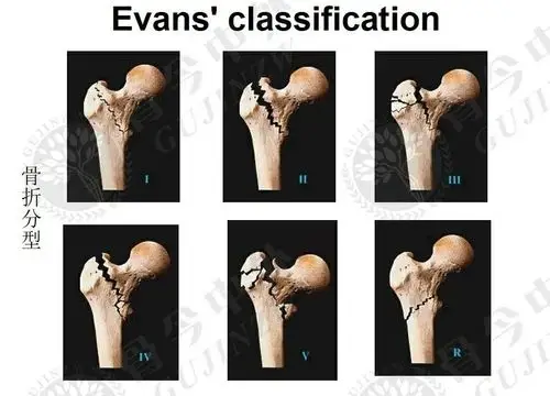 这个股骨粗隆间骨折的evans分型.