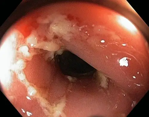 肛癌早期症状图片 (11)_有来医生