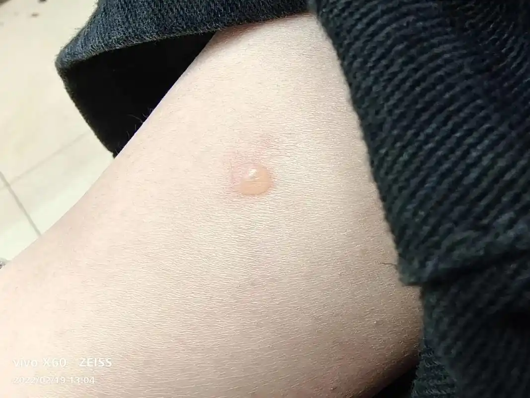 就腿上这个水泡,去医院挂个号,到医院医生说是烫伤,咱还不知道 - 抖音