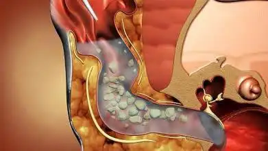 油耳简介:什么是油耳,油耳怎么清理