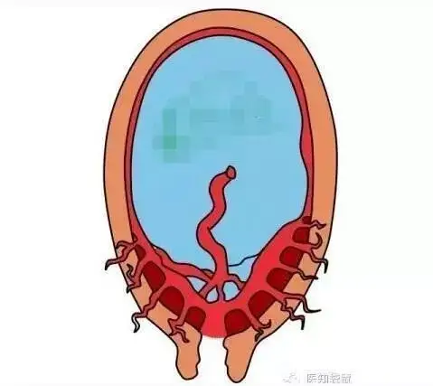 二胎妈妈渡"生死劫",安琪儿多科联手(mdt)成功抢救"凶险性前置胎盘"