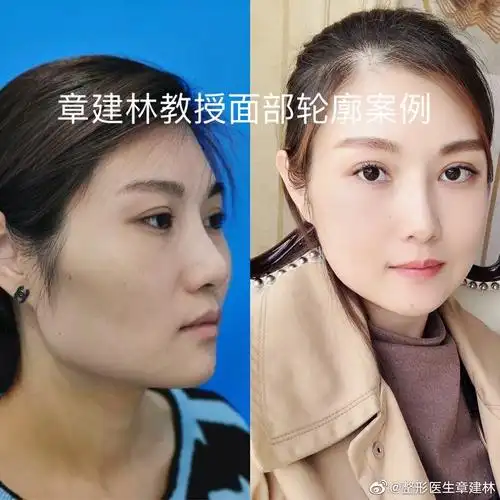 整形改脸型价格深圳王勇医生做改脸型手术怎么样?价格明细明细?