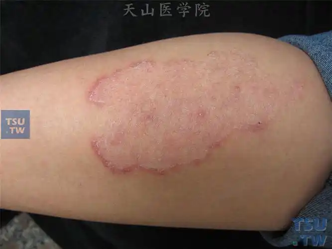体癣(tinea corporis)的症状表现