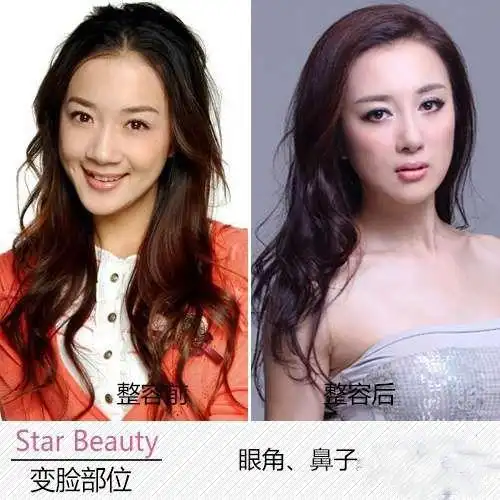 李依晓整容5次动刀整容变大美女